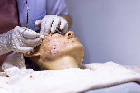 メンズ美容皮膚科でのニキビ治療事例と男性特有の悩み