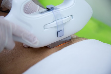 メンズ脱毛に適したレーザー機器と選び方―ヒゲやVIOにおすすめの種類